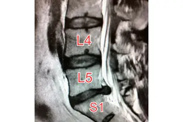 Bel Fıtığı L4 L5 Nedir?