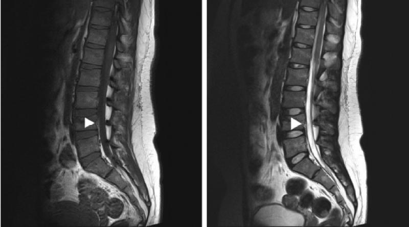 Anterior Epidural Anestezi Nasıl Yapılır?