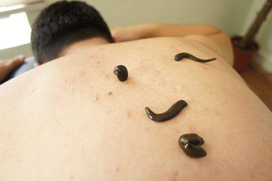 Bel Fıtığı Sülük Tedavisi